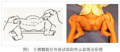 宝宝腿纹不一样