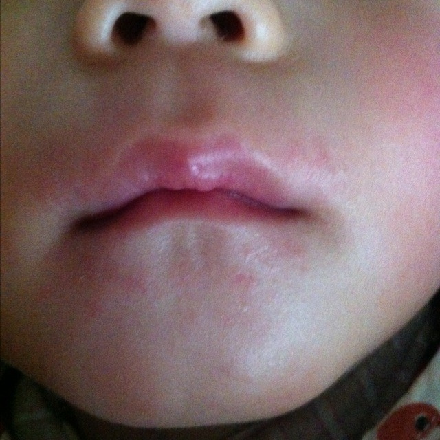 宝宝嘴巴周围和下巴哦起了好多红点点,不知道是不是湿疹,白天不怎么显