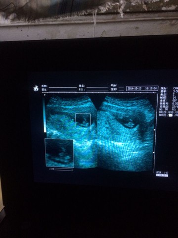 12周彩超看胎儿性别,男孩附小jj图片,准确率多少啊?