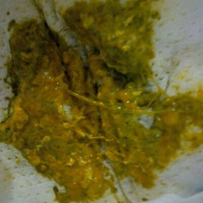 宝宝十六天,母乳餵养,今天拉的便便带拉丝,怎麼回事呢