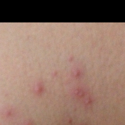 亲们起热痱子了吗 现在35周大腿根部长了红疙瘩很多天了 有点痒还有点