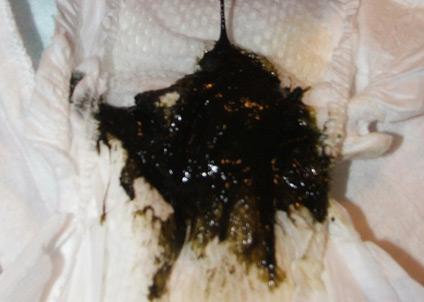 转:宝宝大便图解-真实图片哦 要做好心理准备再进