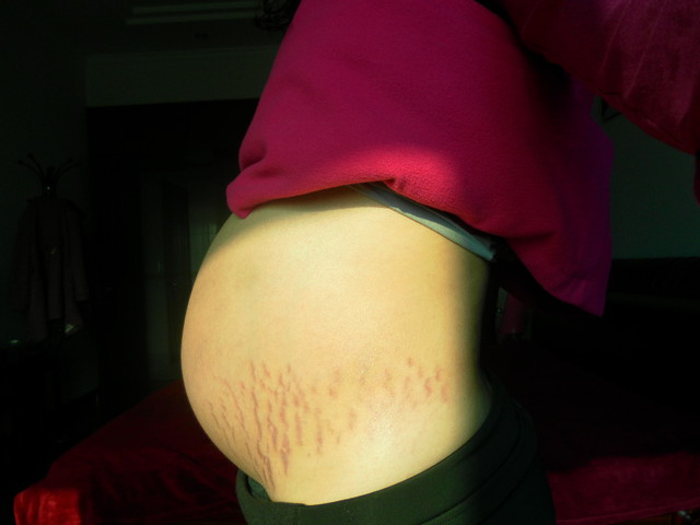 主题:34周的西瓜肚 全是花 惨啊