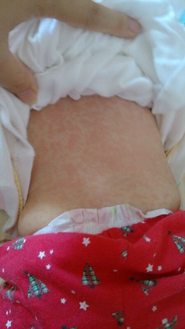 宝宝反复发烧一个多星期了,昨天发现身上全长这些,有知道这是什么的