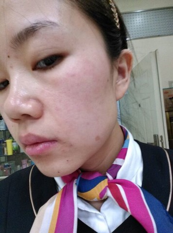 脸上长了很多红色的类似疹子的东西,"毁容"前先擦过维e,正在擦郁美净
