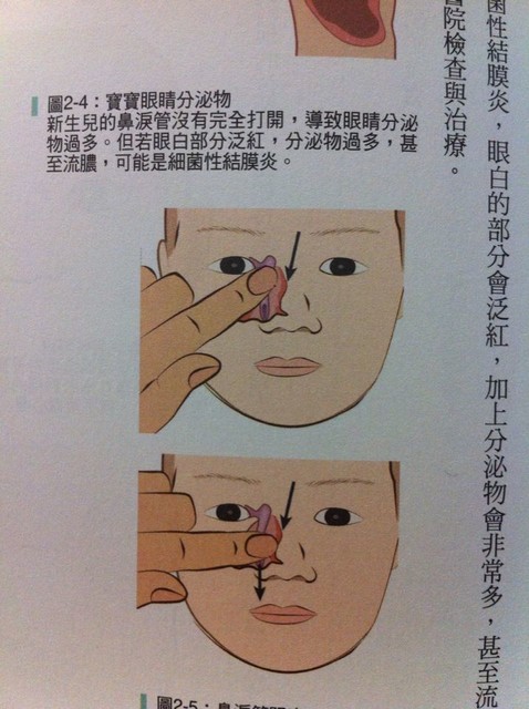 鼻泪管不通每天按图中的方法按摩