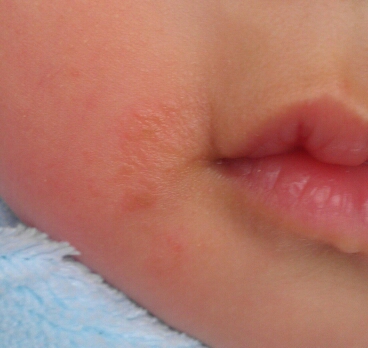 婴幼儿嘴角疱疹图片图片