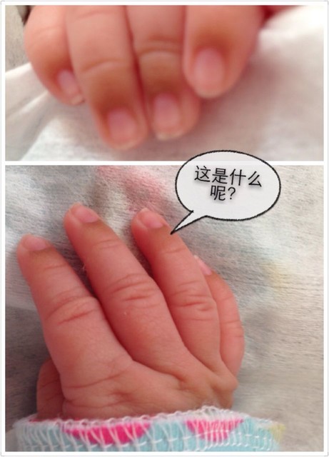 求宝妈帮忙看看宝宝的手指甲下第一个关节皮肤