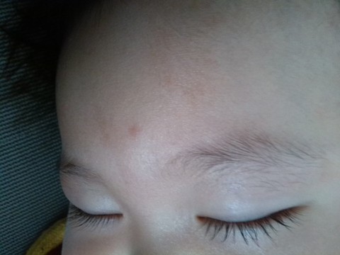 婴儿脸上褐色斑图片图片