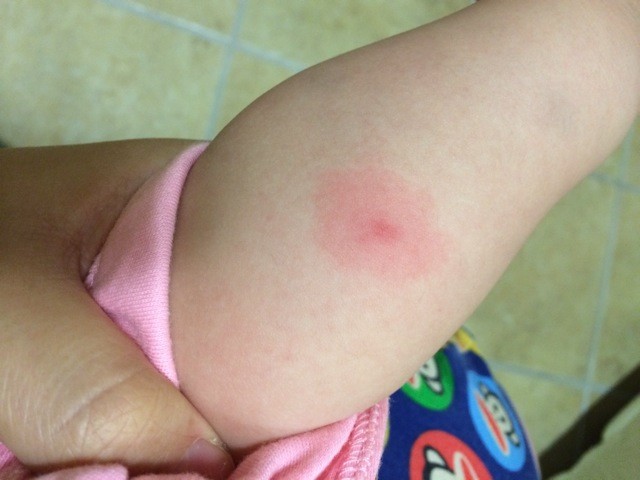 宝宝手臂,腿上各有几个这样的小红疙瘩,中间是个小红疙瘩,四周一圈