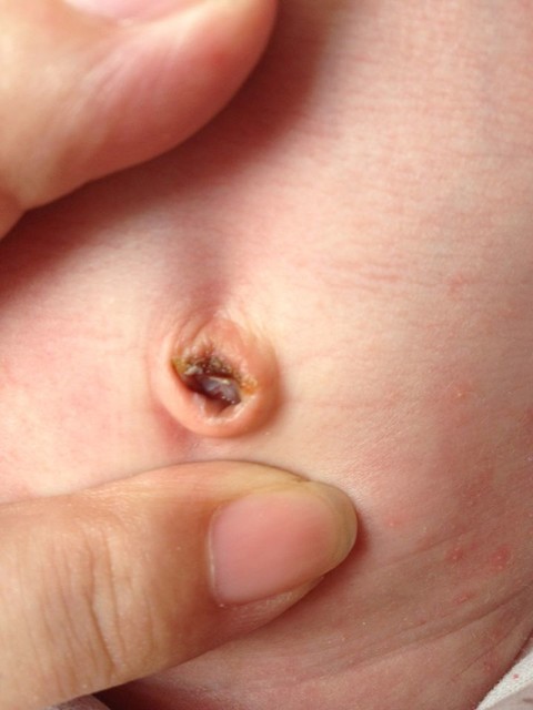 新生儿肚脐炎症状图片图片