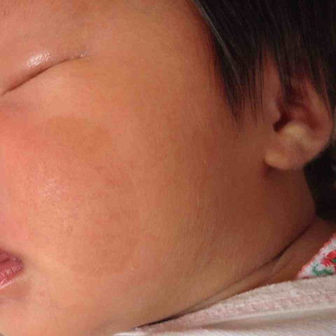 新生儿斑痣图片