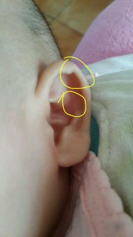 宝宝耳朵对耳轮少一块软骨,耳廓上边尖尖的