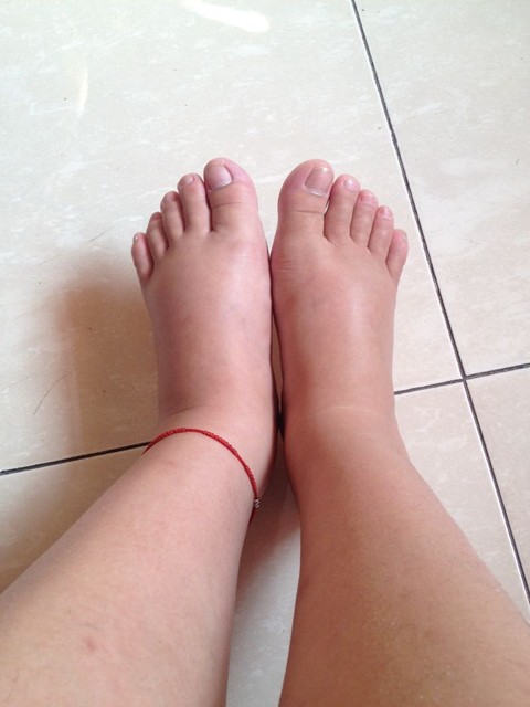 有没有宝妈39周左右腿脚突然发生水肿的.