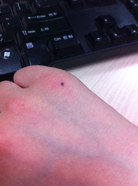 手上长了一个黑点