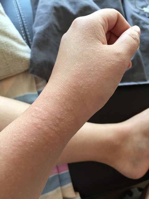 姐妹们帮忙看下 手和手腕上起了好多小疙瘩