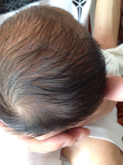 宝宝十几天了,出生时产道积压的右边头凸出!