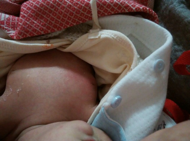 女宝新生儿右边乳房比左边红肿很多怎么办?