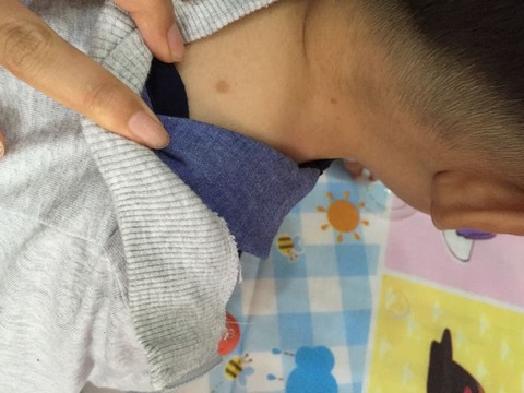 婴儿咖啡斑?神经纤维瘤?