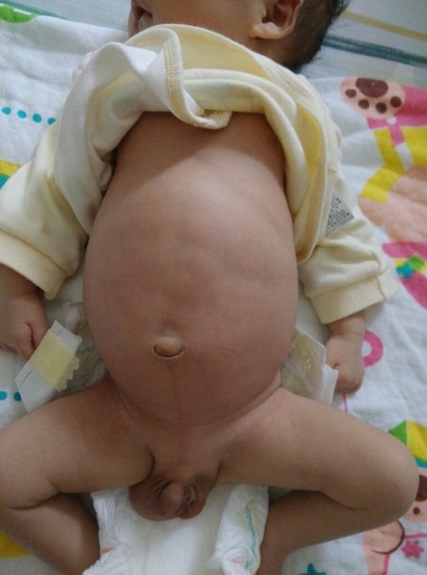 宝宝肚子鼓成这样正常吗?