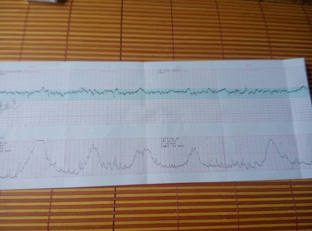 给你看我的我是问你肚皮感觉到了宫缩没有 胎心监测也有假宫缩的