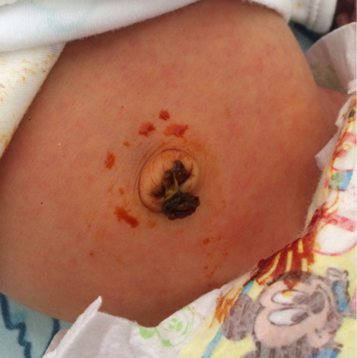 宝宝肚脐眼湿疹图片图片