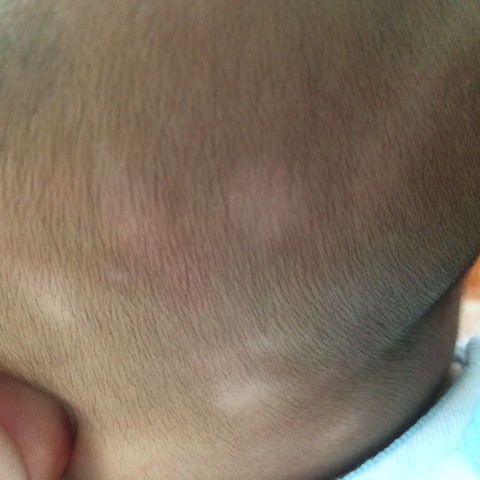 婴儿头皮上有白斑图片图片