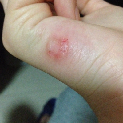 水泡然后烂成这样啊,一直向外延,手上有两处.怀孕了又不能用药.