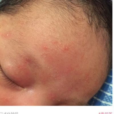 宝宝20天,脸上是痱子还是湿疹?