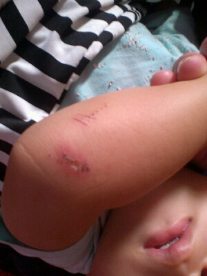 宝宝手擦伤了可以用75%酒精消毒嘛?擦上去他会痛,怎麼办?