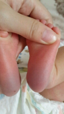 宝宝第四天抽足跟血,两脚被医生用劲挤压却只滴出一滴半,医生说要三滴