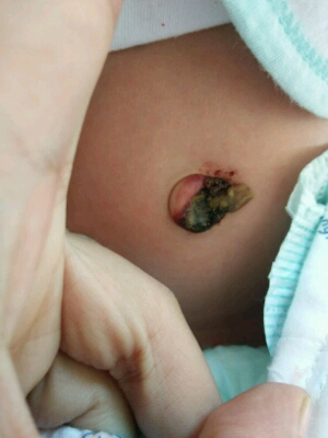 新生儿肚脐发炎图片图片