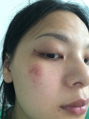 急急急,脸破皮了,涂了点东西变这样了?该怎麼办?