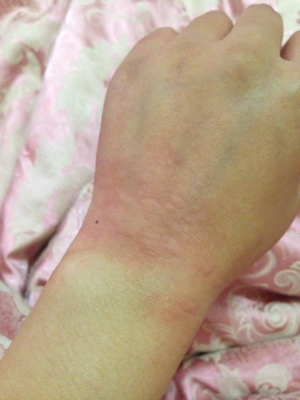 皮肤过敏,手脚和身上都长,一抓就会更多,一片一片的,请问是什麼,怎麼