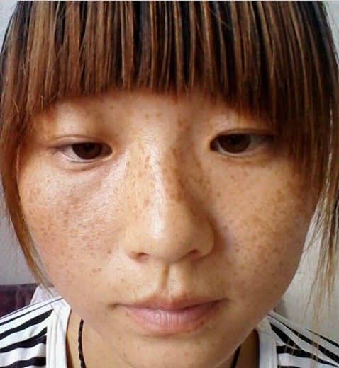 产后很多的妊娠斑呢,怎么办?