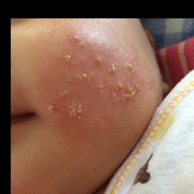 医生你好:我家宝宝从一个多月开始脸上起湿疹小白泡变小黄泡漫漫留脓