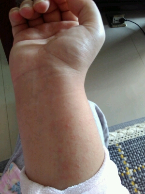 临产妇碘伏过敏怎麼办?涂过碘伏的地方成片的红痒.