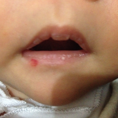 宝宝嘴唇血管瘤图片图片