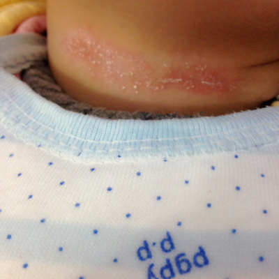 宝宝脖子皱褶处经常反复出现红红的一道,如下图不知道是什么原因,擦药