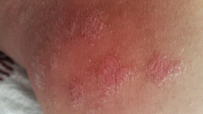 身上长了像图片那样的疹子,是湿疹吗?