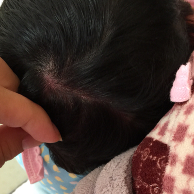 我女儿头皮上有这种红色的,是什麼情况啊?就后脑勺这……专家请给看看
