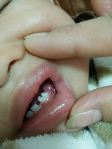 宝宝长牙牙龈鼓包红肿图片