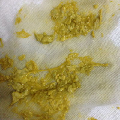 宝宝出生六天拉稀,奶辫子,拉油,怎麼办用什麼药