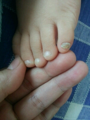 宝宝一出生小拇指甲就不太一样,后来越长大指甲变得越厚,现在2岁多了