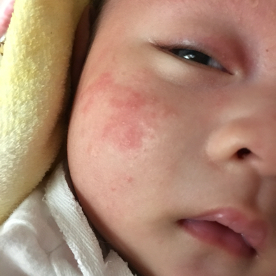 宝宝脸上奶疹子图片图片