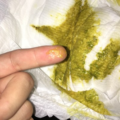 粑粑里有糊状的是什么情况?并且有点绿