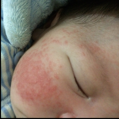 宝宝20天了,长奶癣了,该怎麼办,需要涂药膏治疗么?