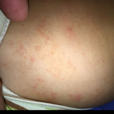 婴儿皮肤干燥起红疹图片