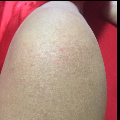 膝盖起荨麻疹图片图片
