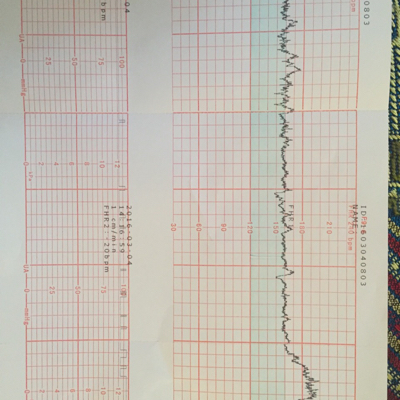 有會看胎心監護的嗎?麻煩幫忙看看